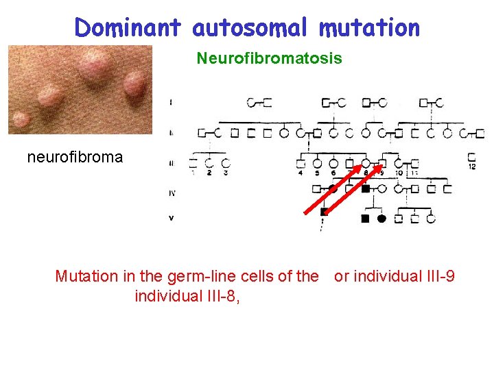 Dominant autosomal mutation Neurofibromatosis neurofibroma Mutation in the germ-line cells of the or individual