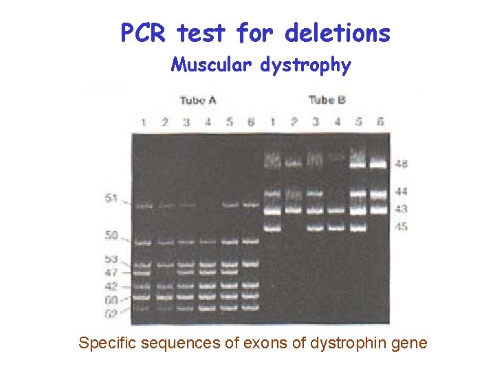 PCR test for deletions Muscular dystrophy Specific sequences of exons of dystrophin gene 