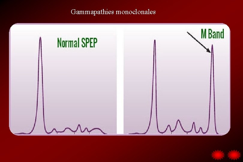 Gammapathies monoclonales 
