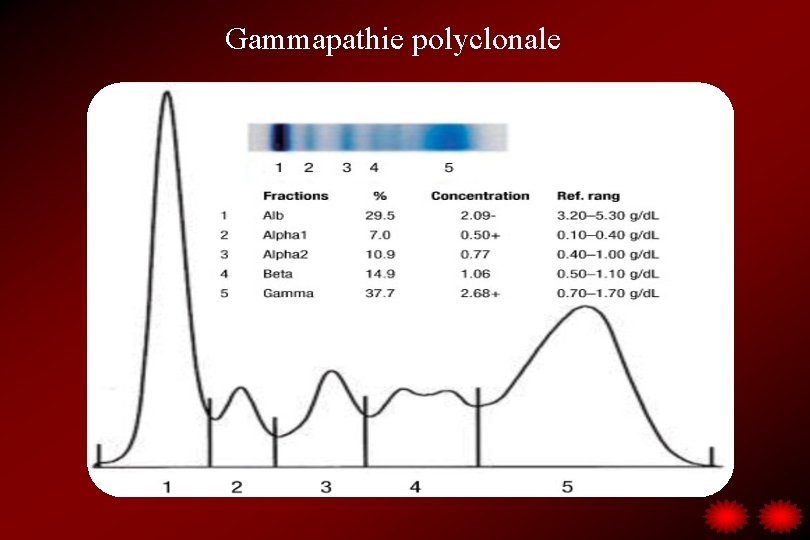 Gammapathie polyclonale 