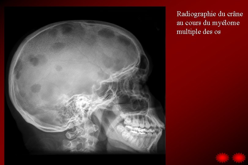 Radiographie du crâne au cours du myélome multiple des os 