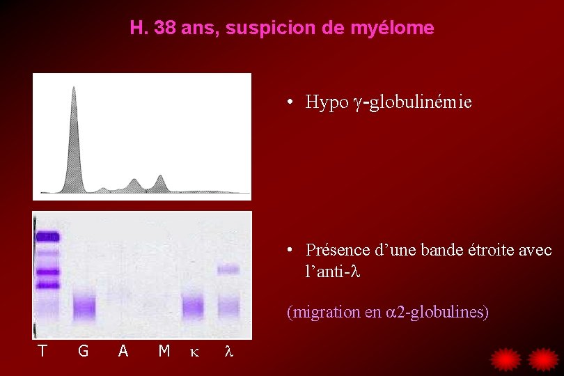 H. 38 ans, suspicion de myélome • Hypo -globulinémie • Présence d’une bande étroite