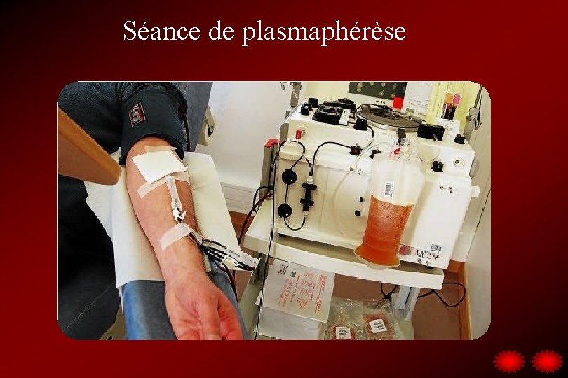 Séance de plasmaphérèse 
