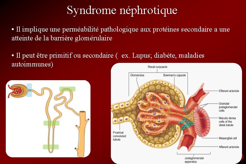 Syndrome néphrotique • Il implique une perméabilité pathologique aux protéines secondaire a une atteinte