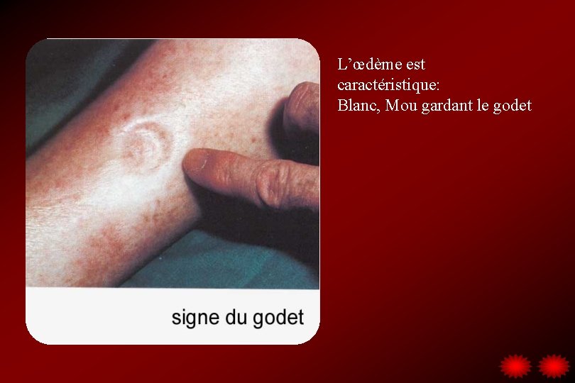 L’œdème est caractéristique: Blanc, Mou gardant le godet 