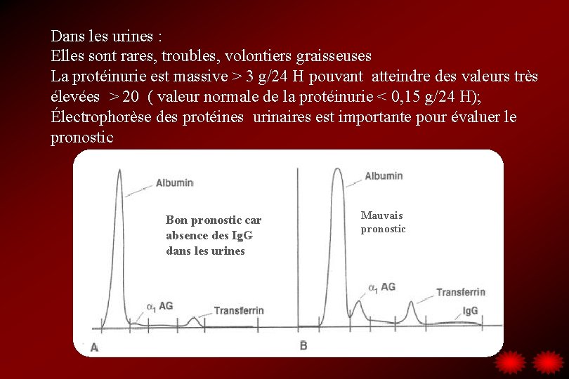 Dans les urines : Elles sont rares, troubles, volontiers graisseuses La protéinurie est massive