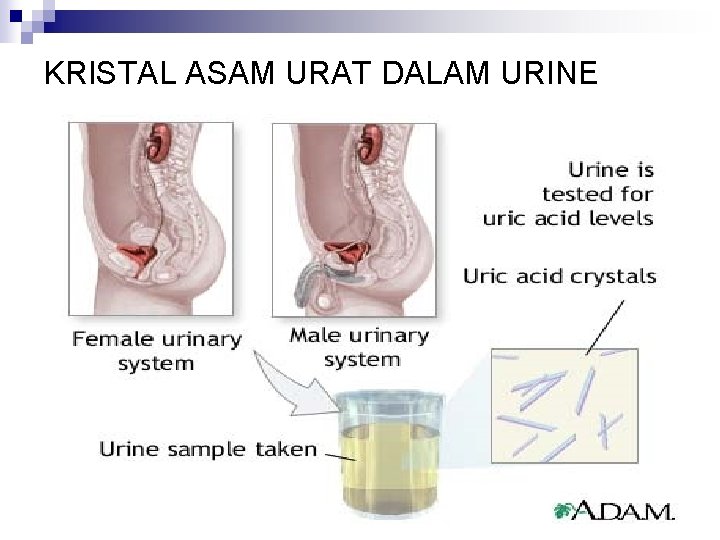 KRISTAL ASAM URAT DALAM URINE 