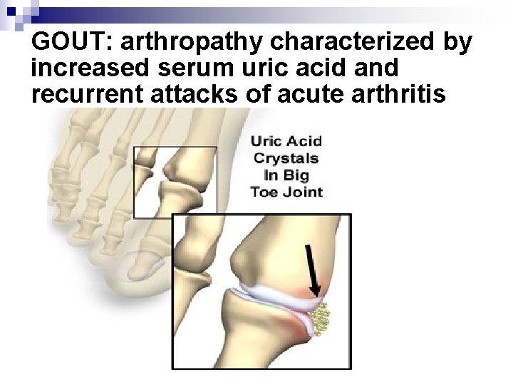 GOUT: arthropathy characterized by increased serum uric acid and recurrent attacks of acute arthritis