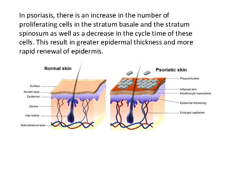 In psoriasis, there is an increase in the number of proliferating cells in the