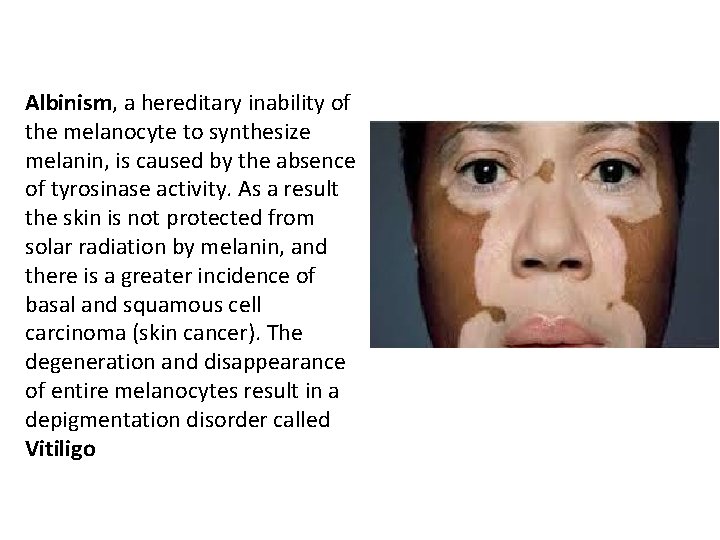 Albinism, a hereditary inability of the melanocyte to synthesize melanin, is caused by the