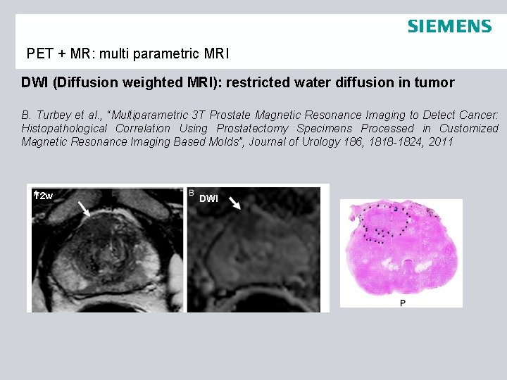 PET + MR: multi parametric MRI DWI (Diffusion weighted MRI): restricted water diffusion in