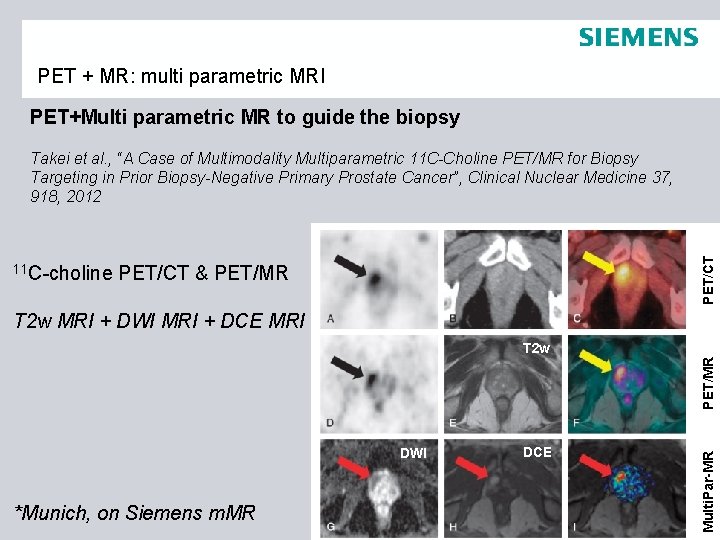 PET + MR: multi parametric MRI PET+Multi parametric MR to guide the biopsy 11