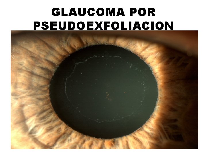 GLAUCOMA POR PSEUDOEXFOLIACION 