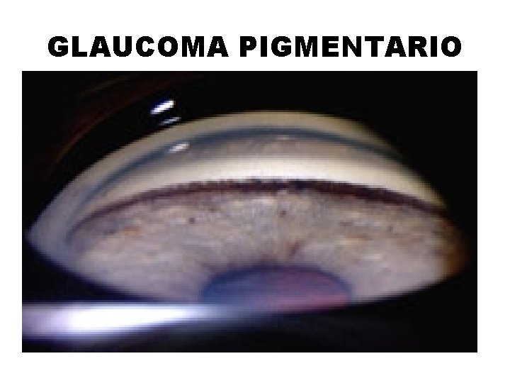 GLAUCOMA PIGMENTARIO 