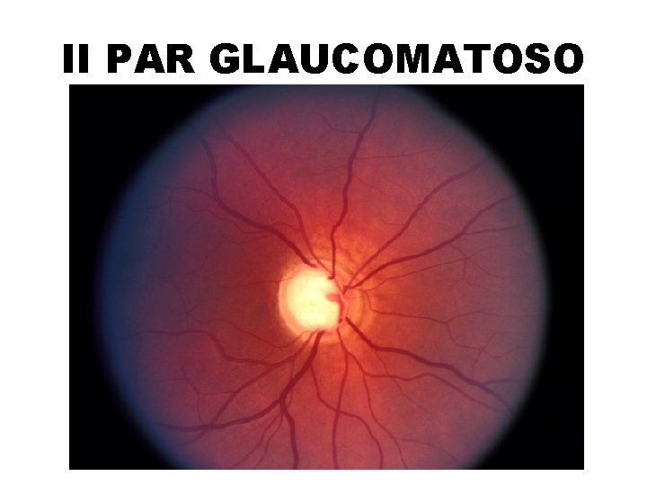 II PAR GLAUCOMATOSO 