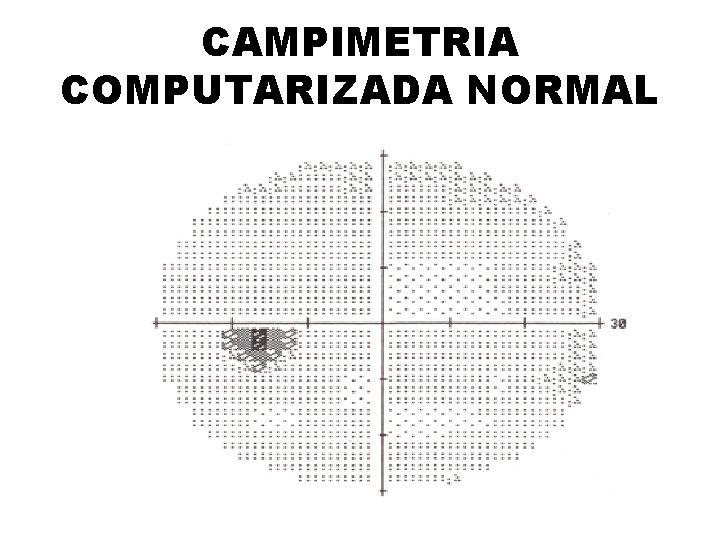 CAMPIMETRIA COMPUTARIZADA NORMAL 