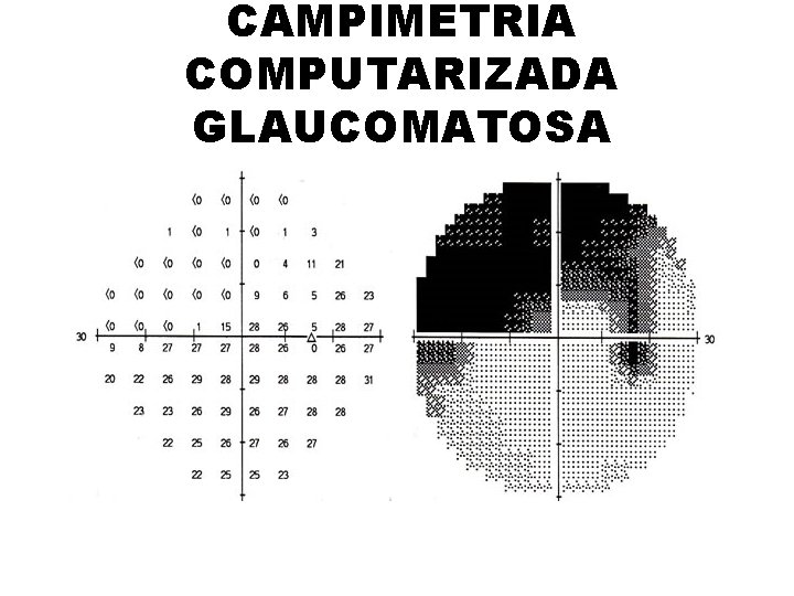 CAMPIMETRIA COMPUTARIZADA GLAUCOMATOSA 