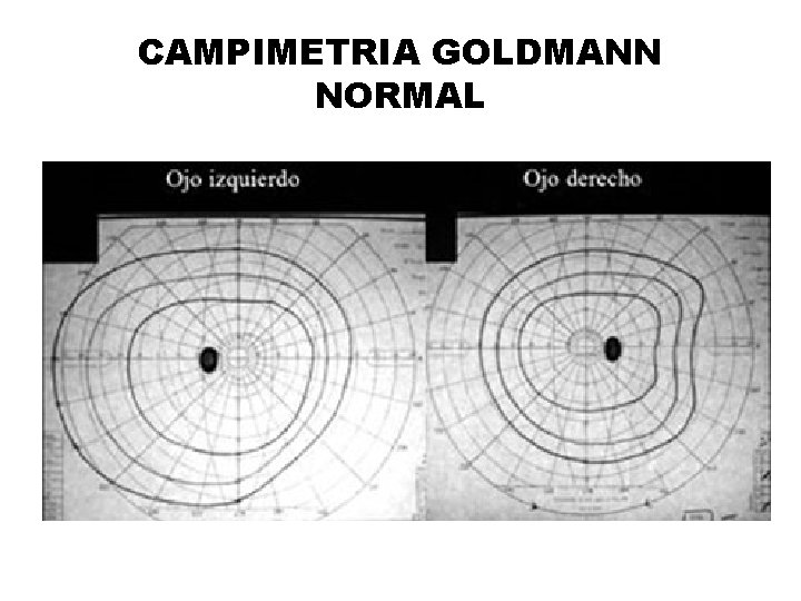 CAMPIMETRIA GOLDMANN NORMAL 