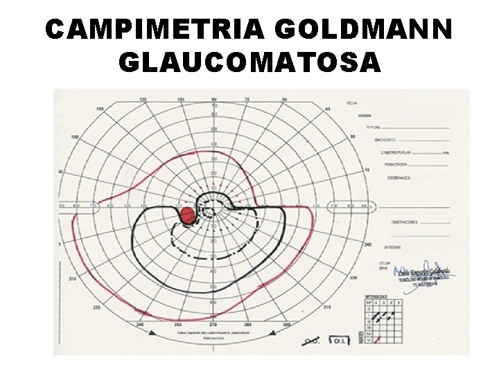 CAMPIMETRIA GOLDMANN GLAUCOMATOSA 