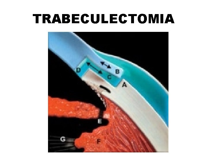 TRABECULECTOMIA 