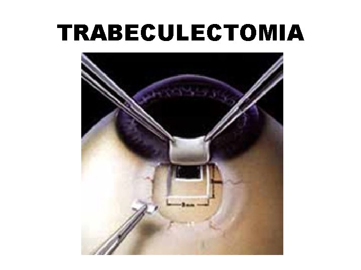 TRABECULECTOMIA 