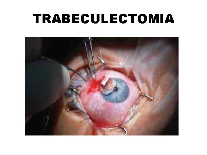 TRABECULECTOMIA 