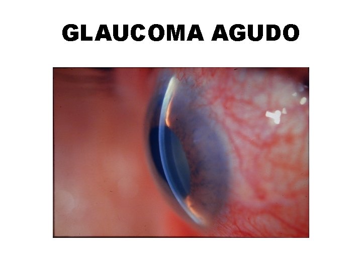 GLAUCOMA AGUDO 