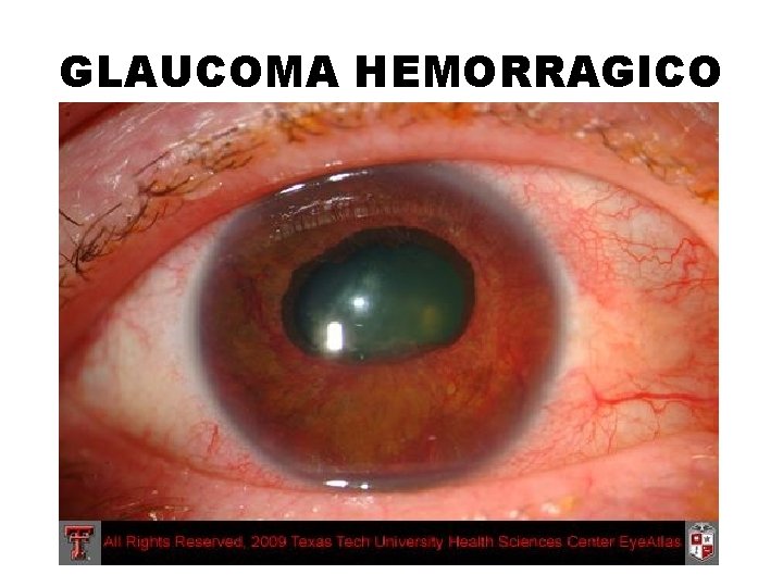 GLAUCOMA HEMORRAGICO 