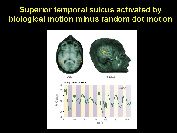 Superior temporal sulcus activated by biological motion minus random dot motion 