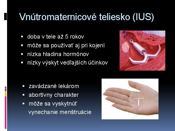 Vnútromaternicové teliesko (IUS) doba v tele až 5 rokov môže sa používať aj pri