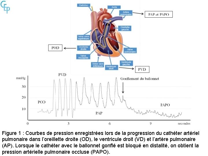 Figure 1 : Courbes de pression enregistrées lors de la progression du cathéter artériel