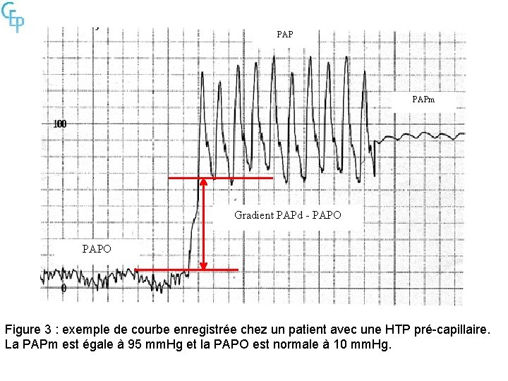 PAP PAPm Gradient PAPd - PAPO Figure 3 : exemple de courbe enregistrée chez