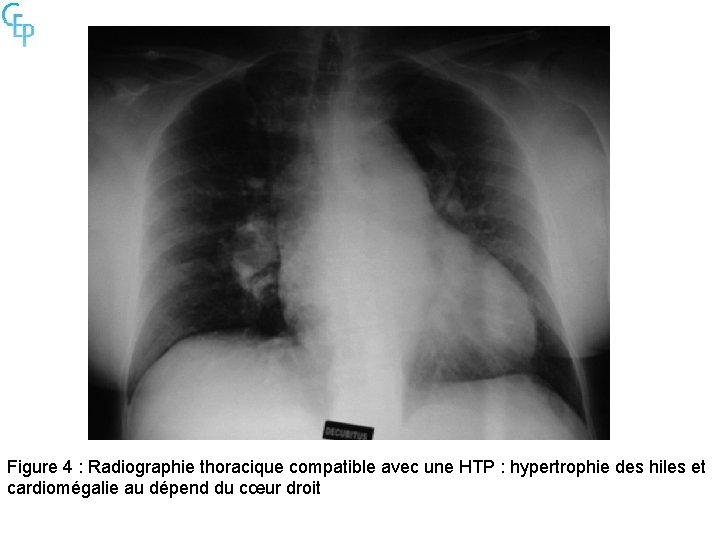 Figure 4 : Radiographie thoracique compatible avec une HTP : hypertrophie des hiles et
