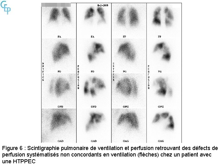 Figure 6 : Scintigraphie pulmonaire de ventilation et perfusion retrouvant des défects de perfusion