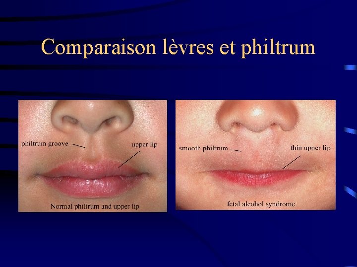 Comparaison lèvres et philtrum 