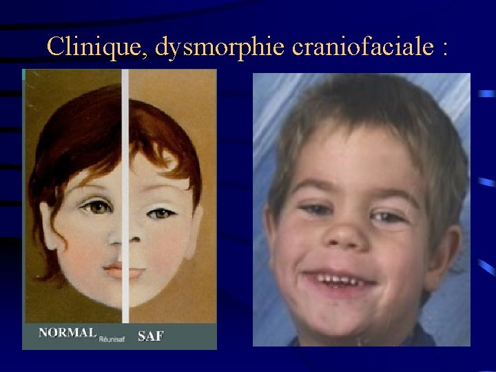 Clinique, dysmorphie craniofaciale : 