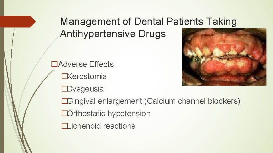 Management of Dental Patients Taking Antihypertensive Drugs �Adverse Effects: �Xerostomia �Dysgeusia �Gingival enlargement (Calcium