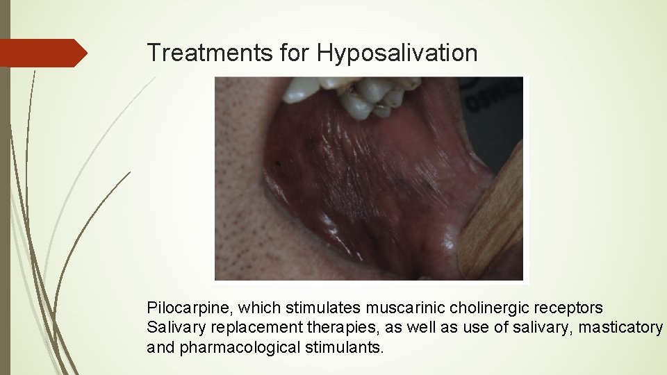 Treatments for Hyposalivation Pilocarpine, which stimulates muscarinic cholinergic receptors Salivary replacement therapies, as well