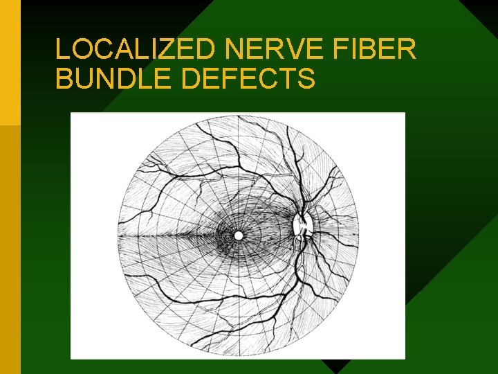 LOCALIZED NERVE FIBER BUNDLE DEFECTS 