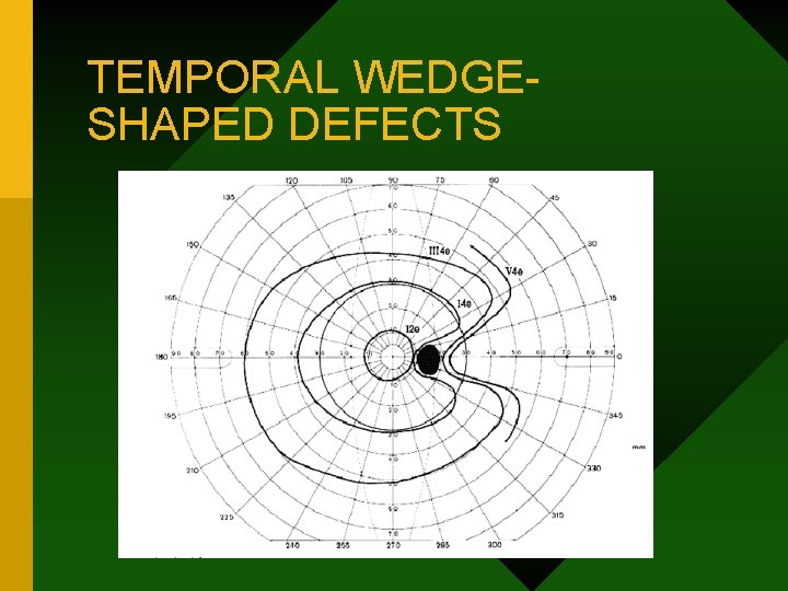 TEMPORAL WEDGESHAPED DEFECTS 