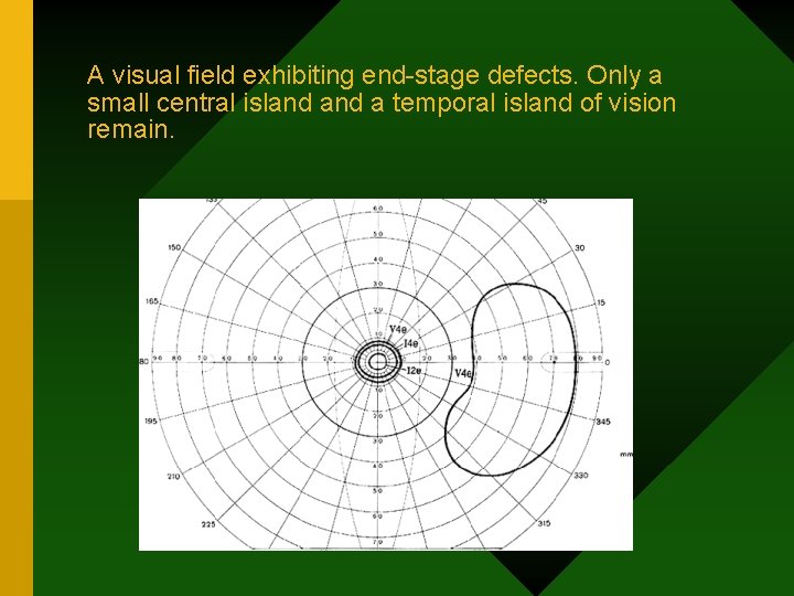 A visual field exhibiting end-stage defects. Only a small central island a temporal island