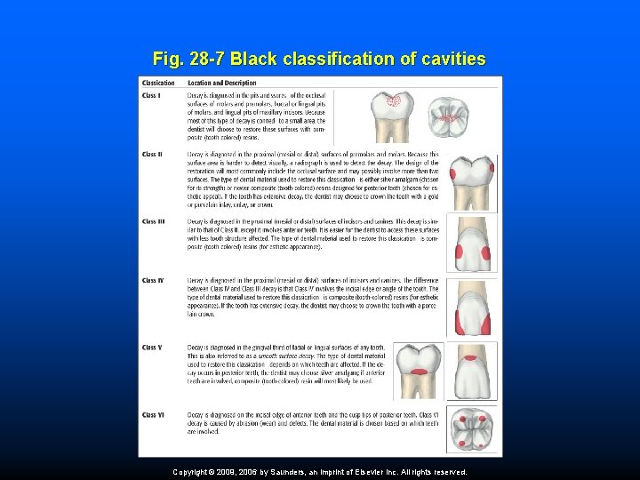 Fig. 28 -7 Black classification of cavities Copyright © 2009, 2006 by Saunders, an