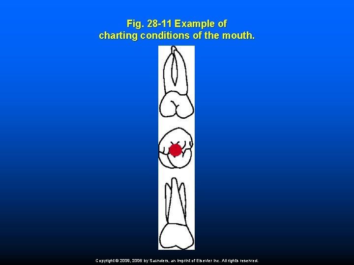 Fig. 28 -11 Example of charting conditions of the mouth. Copyright © 2009, 2006