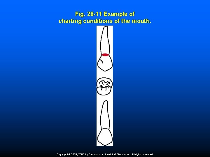 Fig. 28 -11 Example of charting conditions of the mouth. Copyright © 2009, 2006