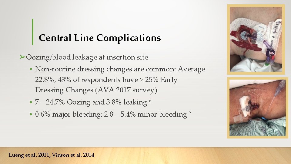 Central Line Complications ➢Oozing/blood leakage at insertion site • Non-routine dressing changes are common: Central Line Complications ➢Oozing/blood leakage at insertion site • Non-routine dressing changes are common: