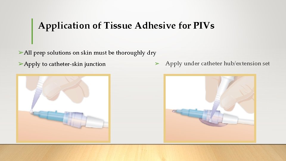 Application of Tissue Adhesive for PIVs ➢All prep solutions on skin must be thoroughly Application of Tissue Adhesive for PIVs ➢All prep solutions on skin must be thoroughly