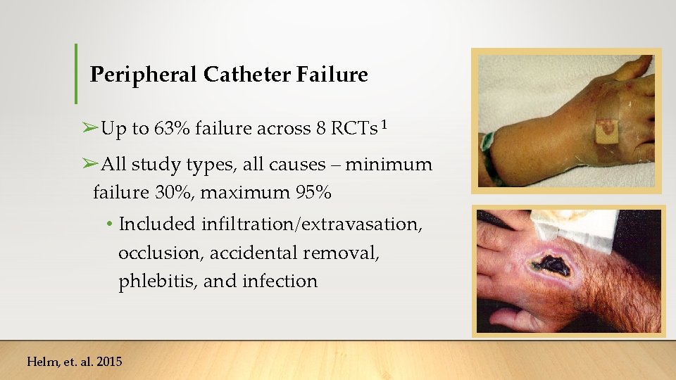 Peripheral Catheter Failure ➢Up to 63% failure across 8 RCTs 1 ➢All study types, Peripheral Catheter Failure ➢Up to 63% failure across 8 RCTs 1 ➢All study types,