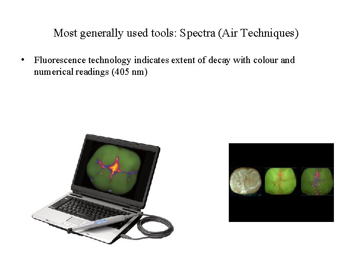 Most generally used tools: Spectra (Air Techniques) • Fluorescence technology indicates extent of decay