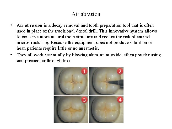 Air abrasion • Air abrasion is a decay removal and tooth preparation tool that