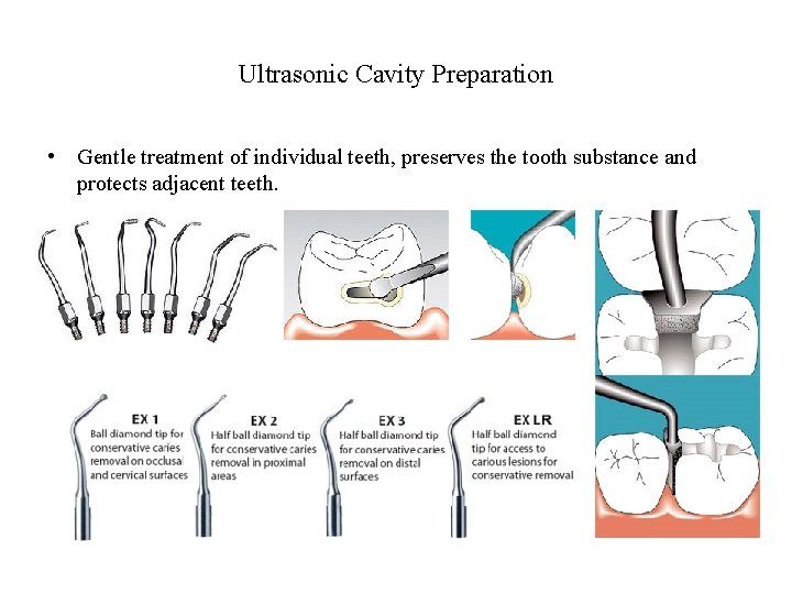 Ultrasonic Cavity Preparation • Gentle treatment of individual teeth, preserves the tooth substance and